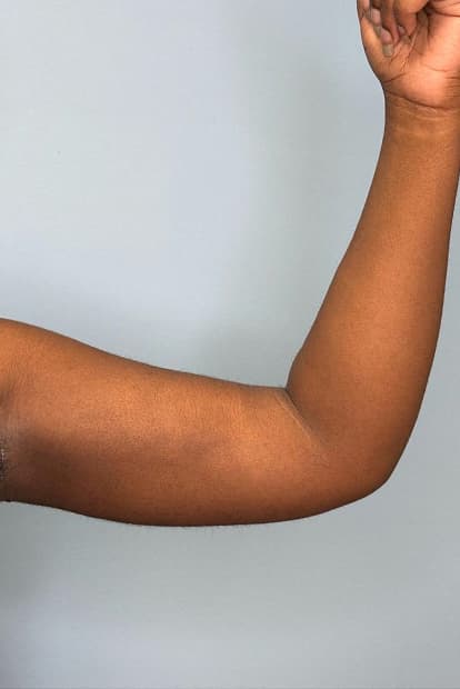 Woman after arm liposuction