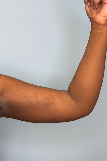 Woman after arm liposuction