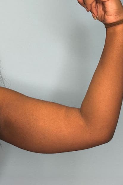 Woman before arm liposuction