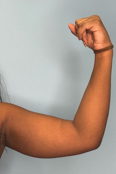 Woman before arm liposuction