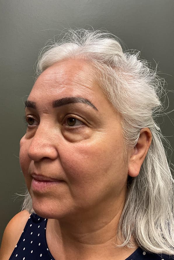 Woman before belaphoplasty