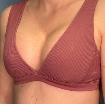 Woman after breast augmentation