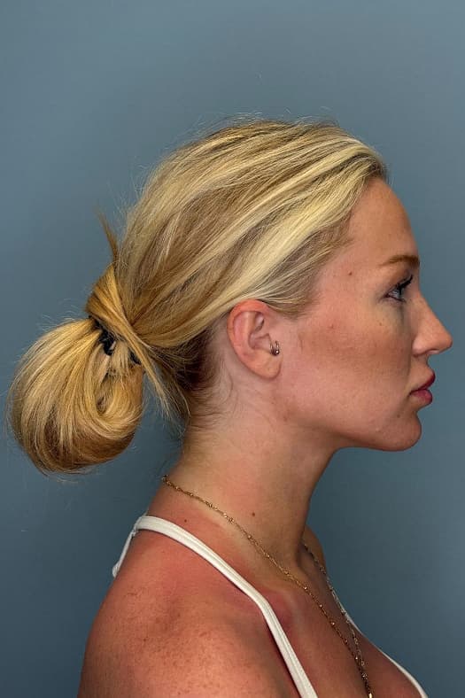 Woman after chin liposuction