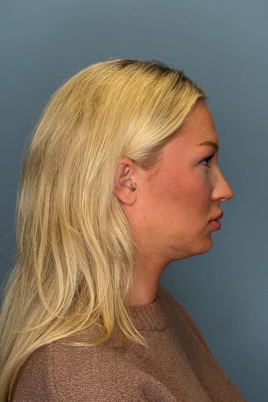 Woman before chin liposuction