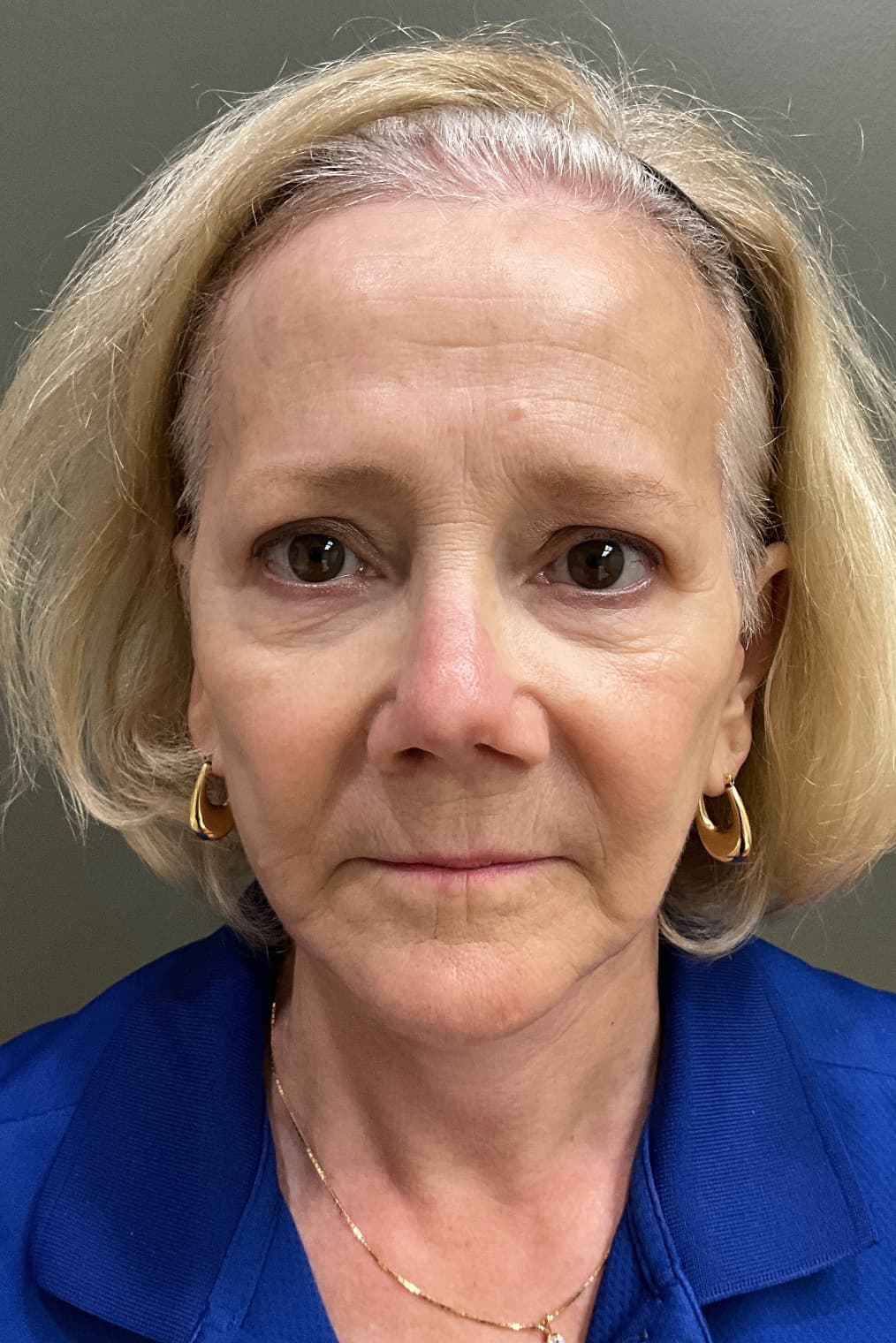Woman after facelift