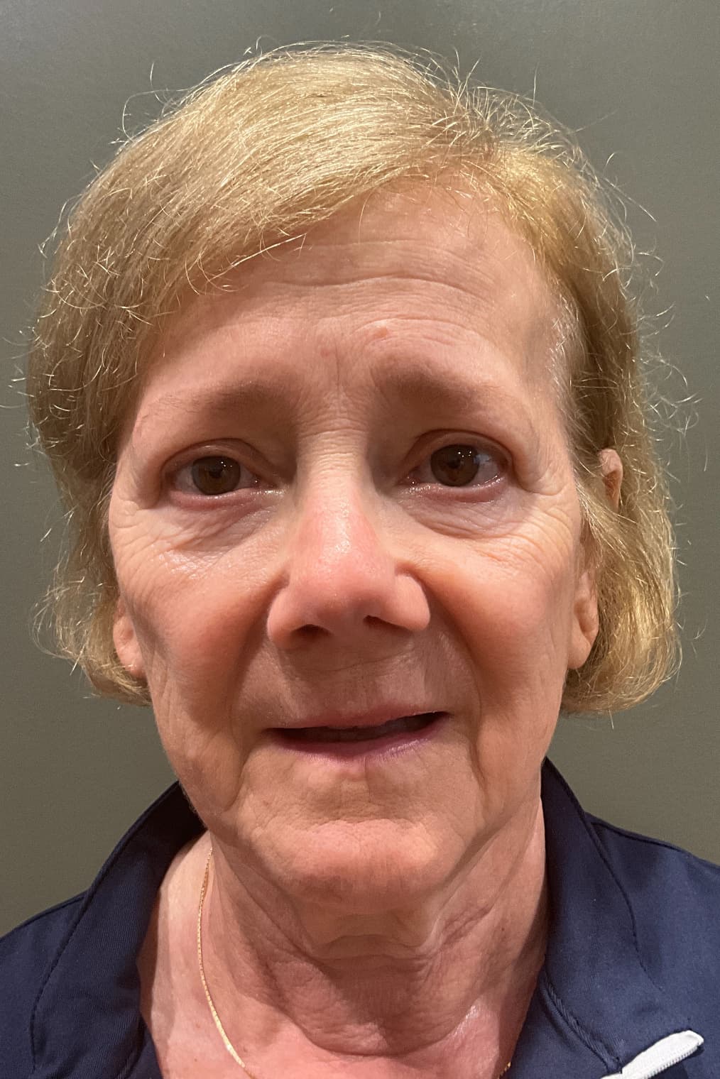 Woman before facelift