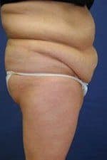 Woman before tummy tuck