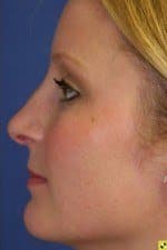 Woman after rhinoplasty