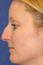 Woman before rhinoplasty