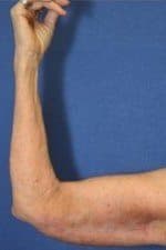 Woman after arm lift