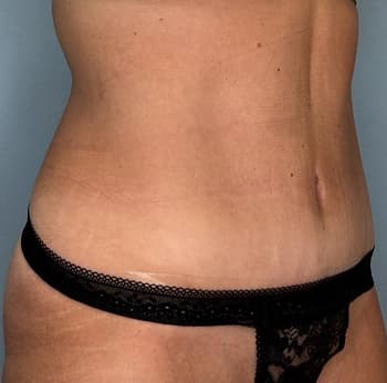 Woman after tummy tuck