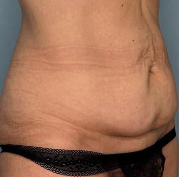 Woman before tummy tuck