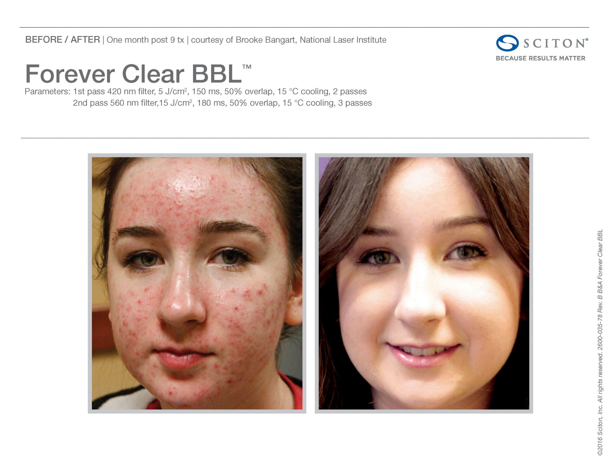 Sophie Rain'S Bbl: A Plastic Surgery Success Story? - ofenizb